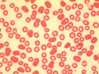Verstoorde zuurstofopname door &#039;lege&#039; rode bloedlichaampjes kenmerkend voor bloedarmoede